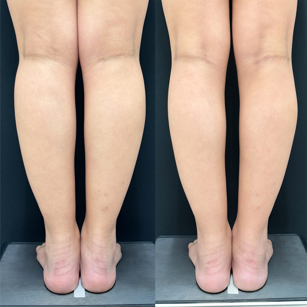 足の脂肪吸引