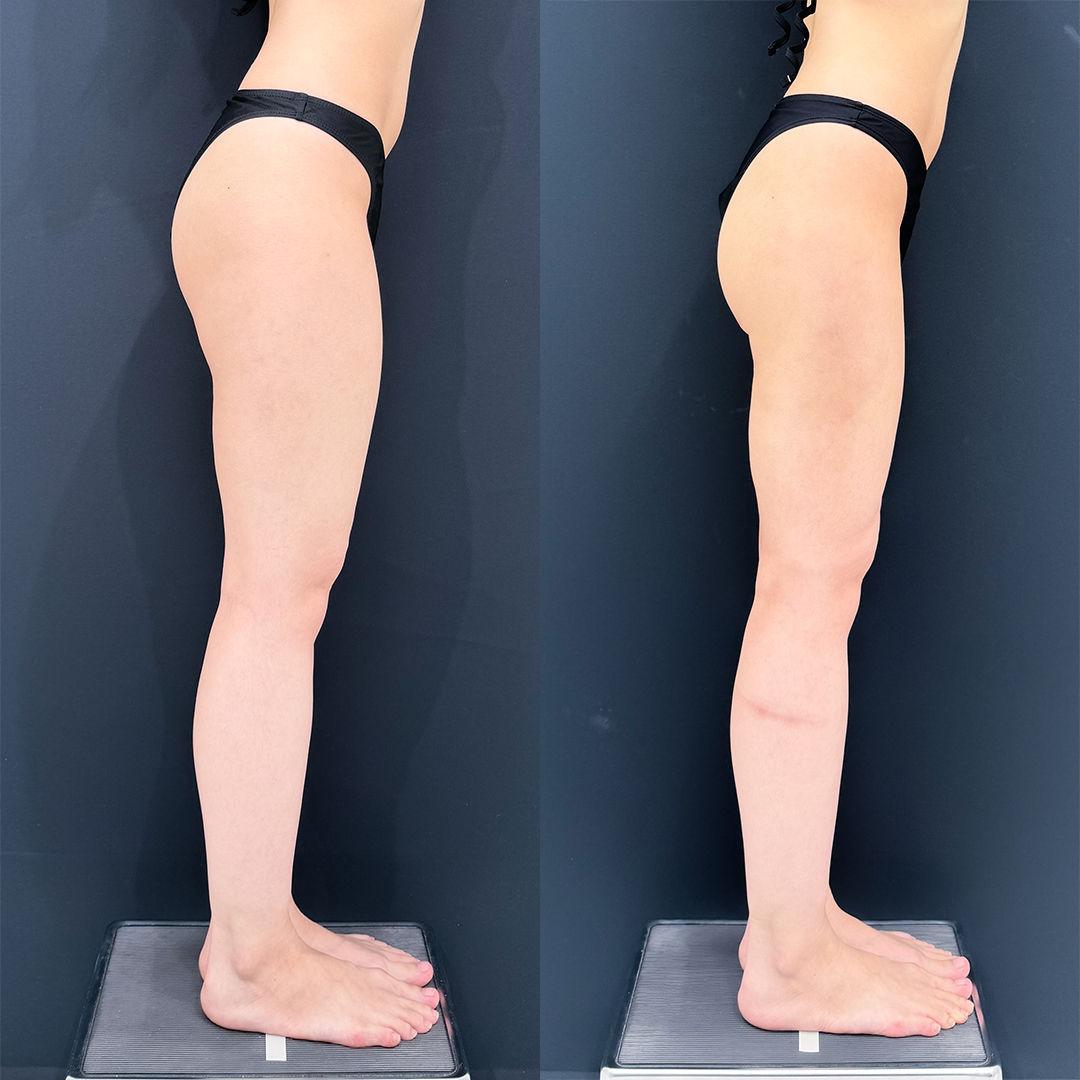 https://purelys-tokyo-clinic.com/wp/wp-content/uploads/2026/01/Liposuction_Case-No.456.jpg