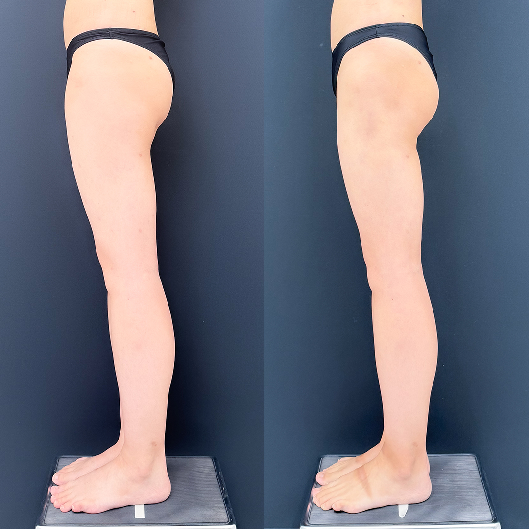 https://purelys-tokyo-clinic.com/wp/wp-content/uploads/2026/01/Liposuction_Case-No.470.jpg