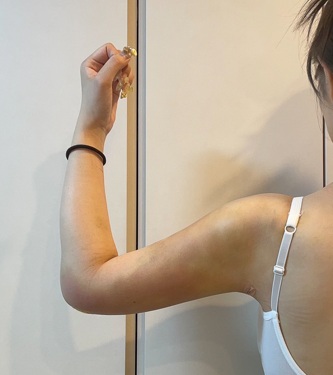 二の腕の脂肪吸引