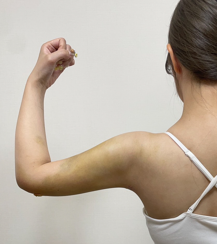 二の腕の脂肪吸引
