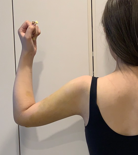 二の腕の脂肪吸引