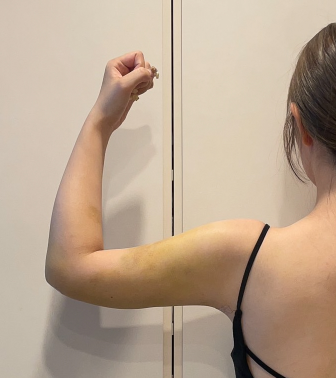 二の腕の脂肪吸引