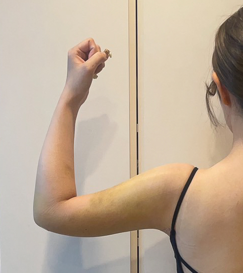 二の腕の脂肪吸引