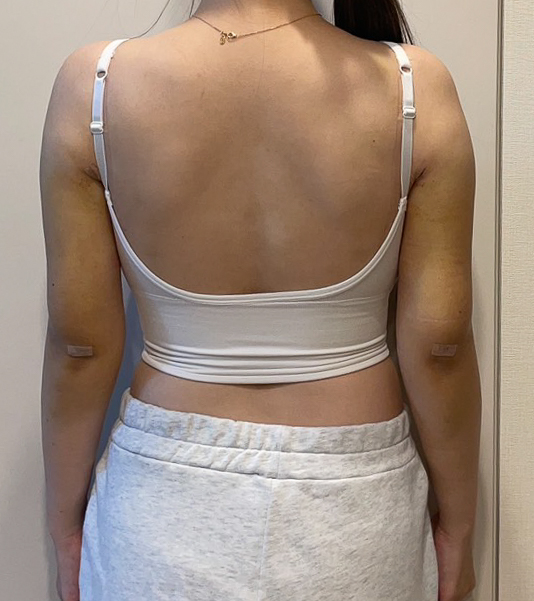 二の腕の脂肪吸引