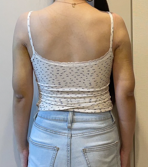 二の腕の脂肪吸引