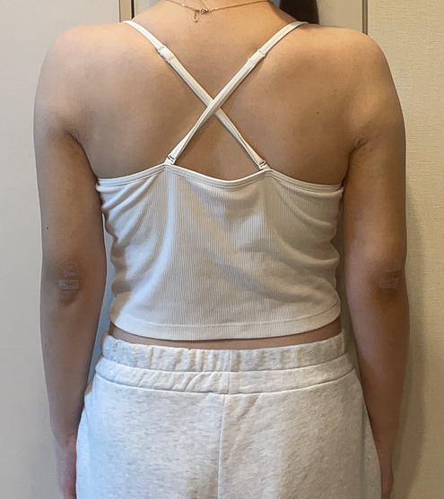 二の腕の脂肪吸引