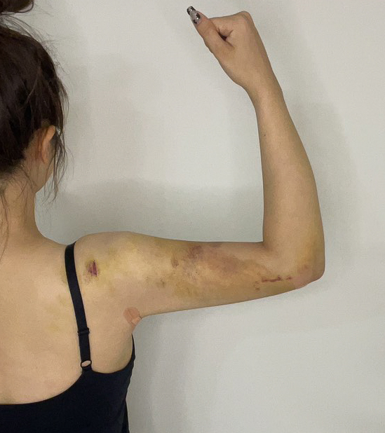 二の腕の脂肪吸引