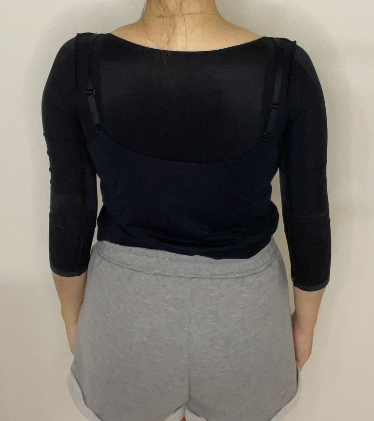 二の腕の脂肪吸引
