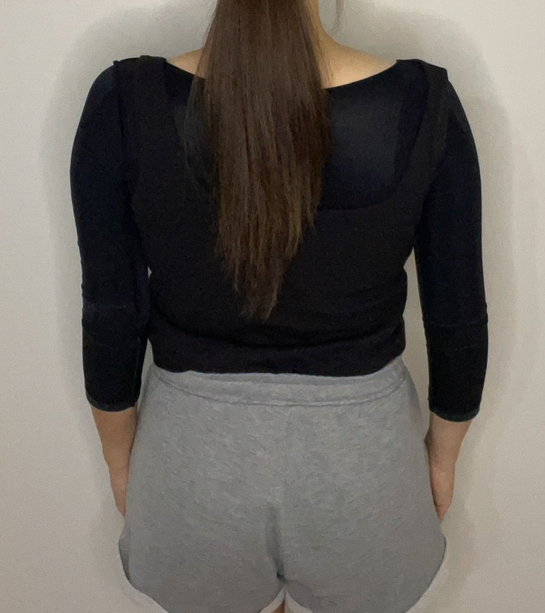 二の腕の脂肪吸引