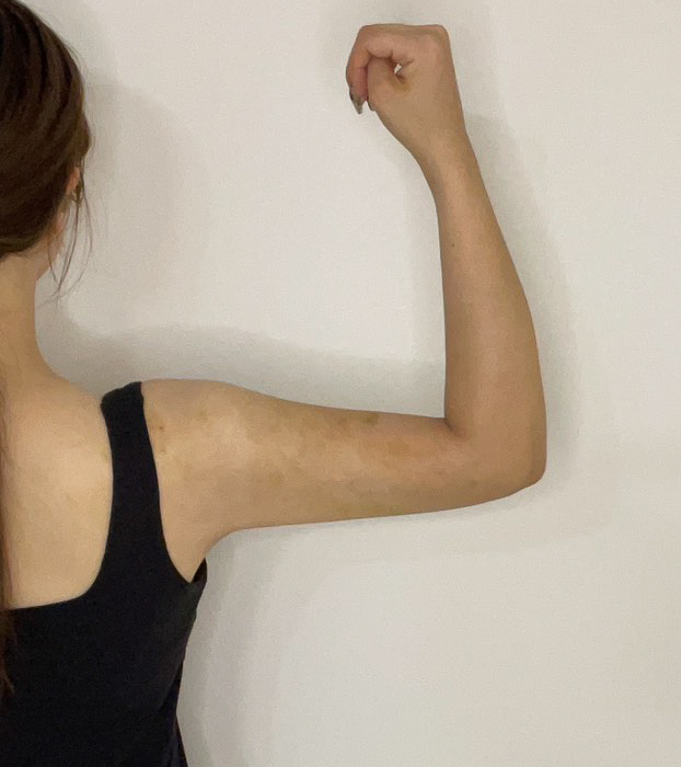 二の腕の脂肪吸引