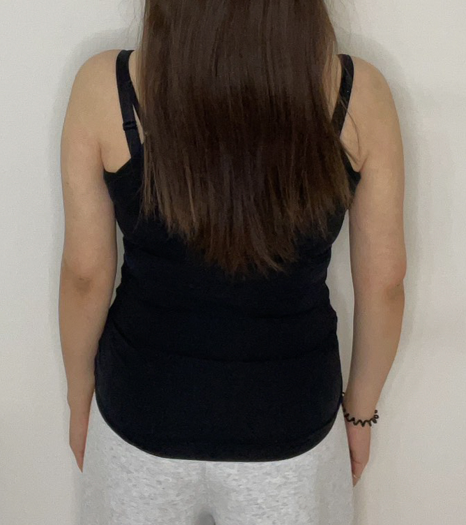 二の腕の脂肪吸引