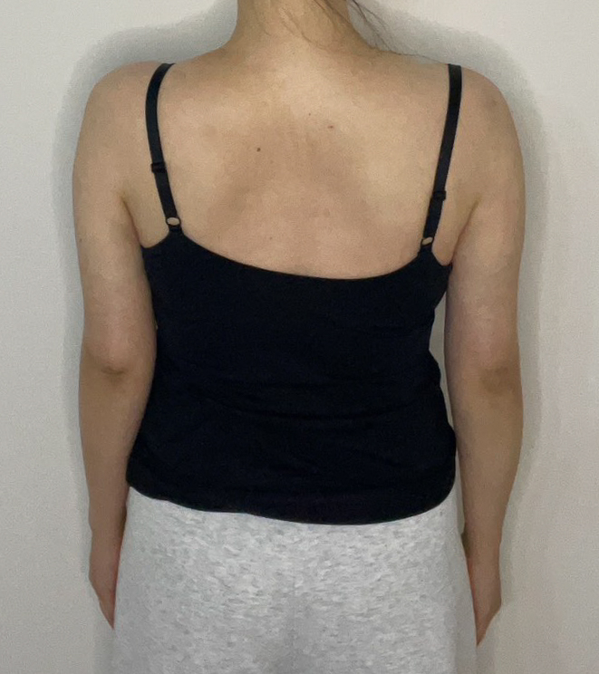 二の腕の脂肪吸引