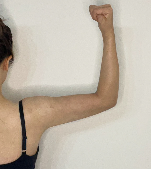 二の腕の脂肪吸引