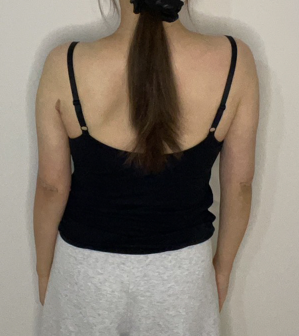 二の腕の脂肪吸引