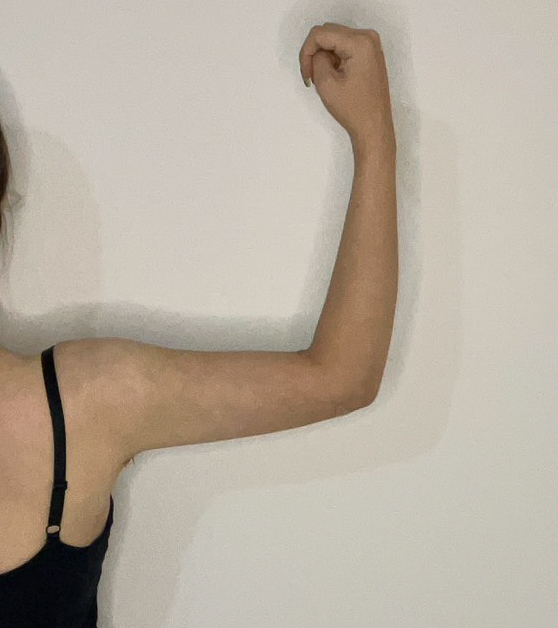 二の腕の脂肪吸引