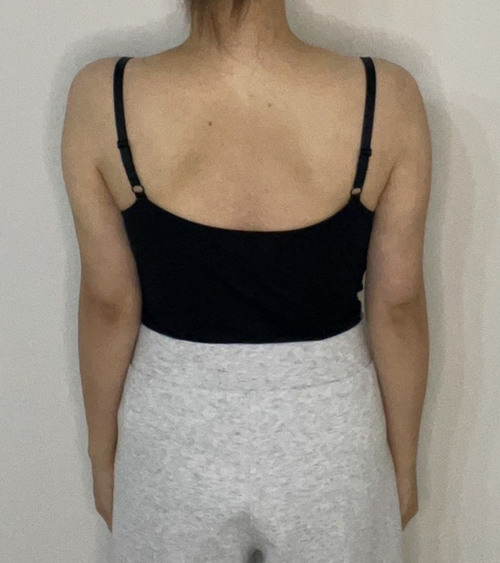 二の腕の脂肪吸引