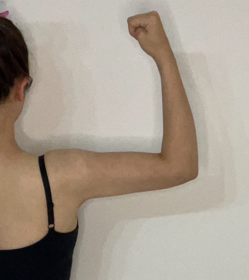 二の腕の脂肪吸引