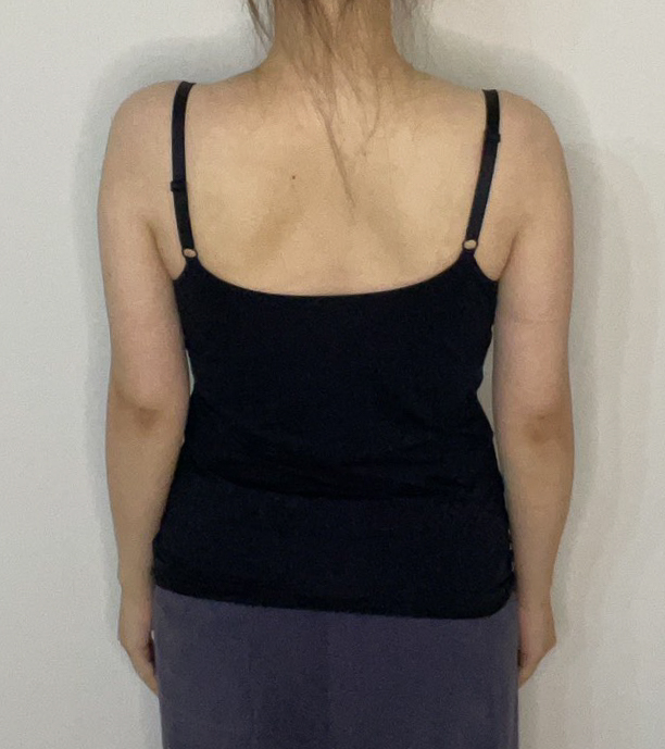 二の腕の脂肪吸引