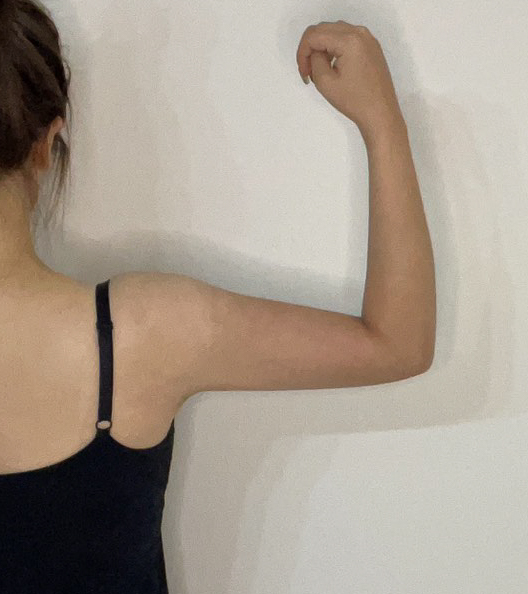 二の腕の脂肪吸引