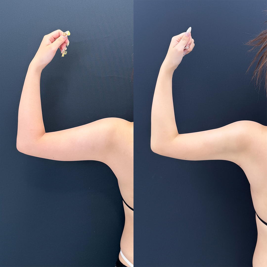 https://purelys-tokyo-clinic.com/wp/wp-content/uploads/2026/01/arm-Liposuction_Case-No.317.jpg