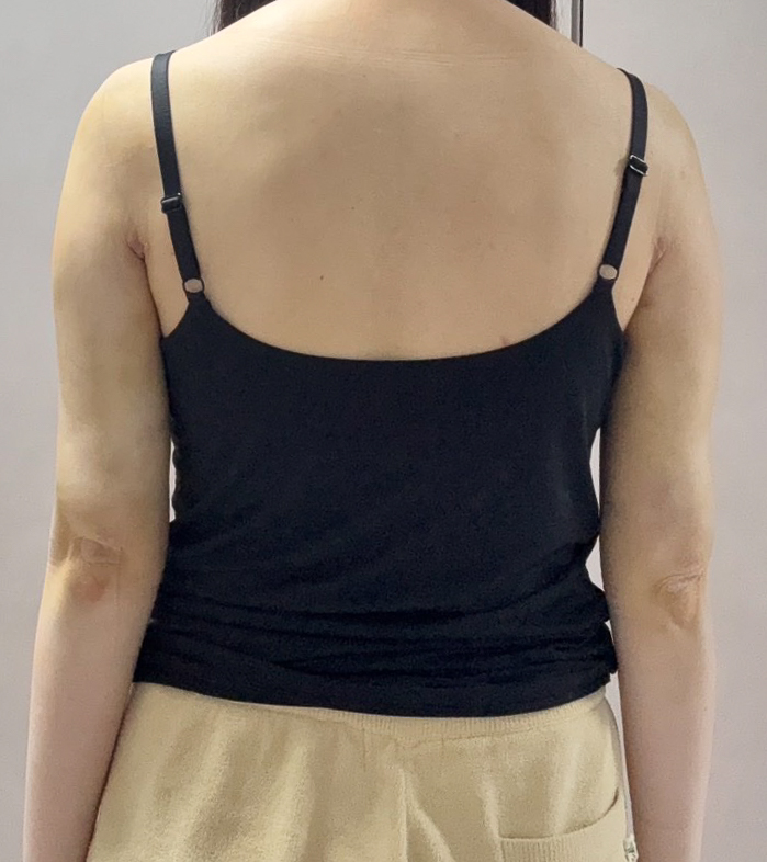 二の腕の脂肪吸引