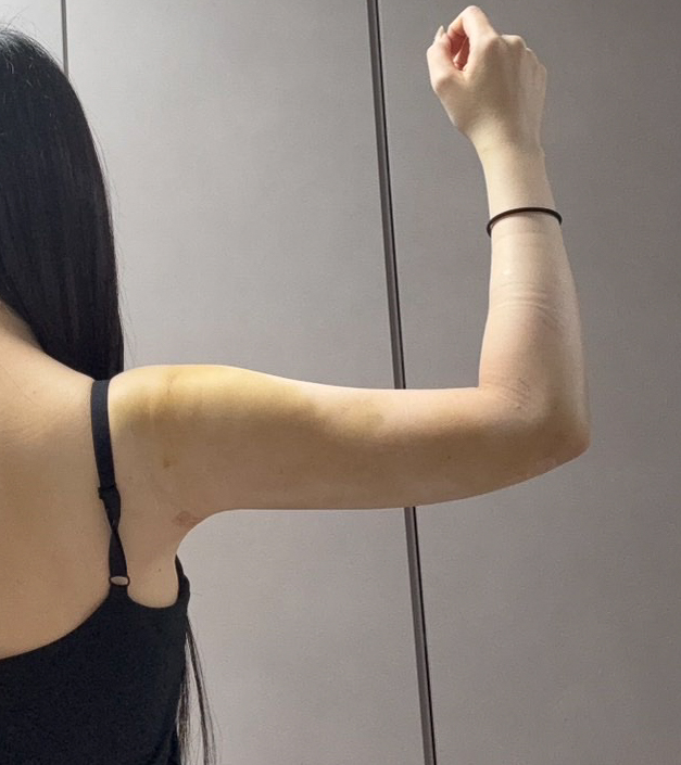 二の腕の脂肪吸引