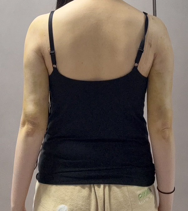 二の腕の脂肪吸引