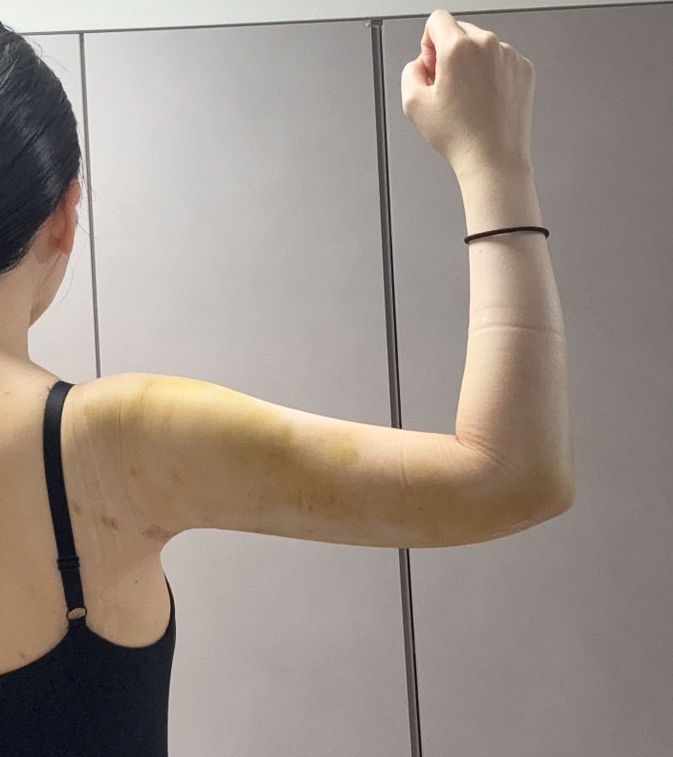 二の腕の脂肪吸引