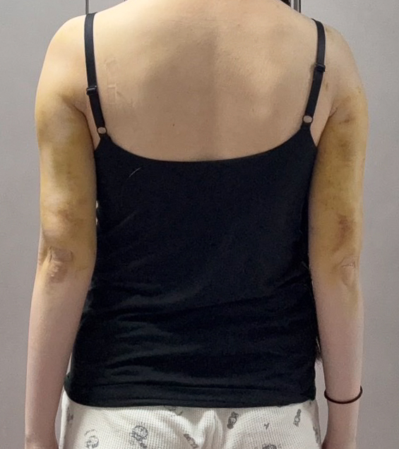 二の腕の脂肪吸引