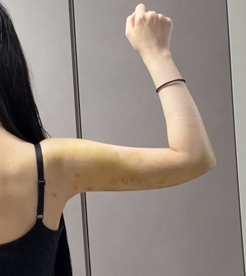 二の腕の脂肪吸引