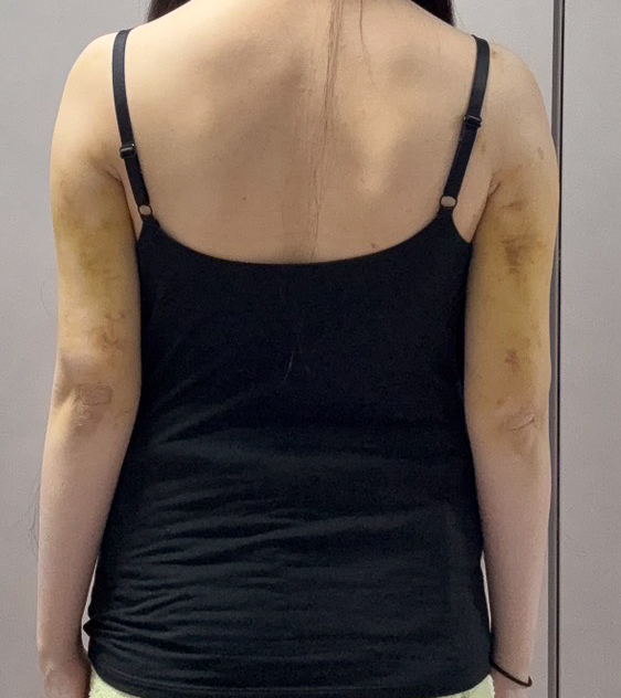 二の腕の脂肪吸引