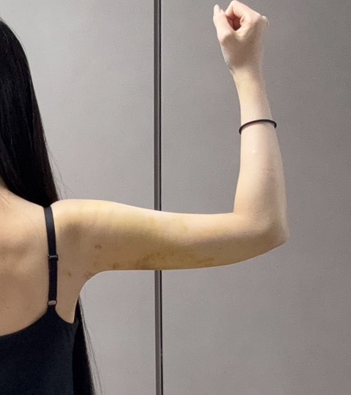 二の腕の脂肪吸引