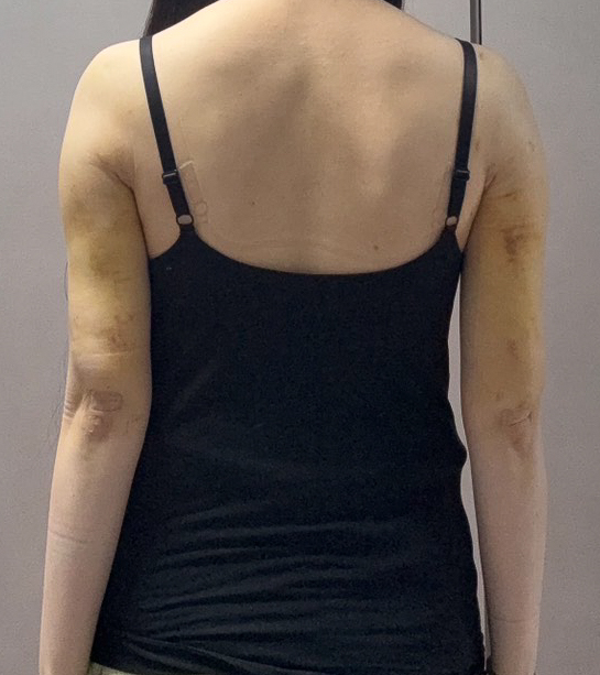 二の腕の脂肪吸引