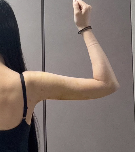 二の腕の脂肪吸引