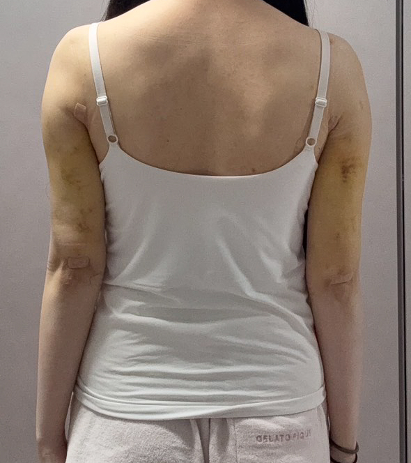 二の腕の脂肪吸引