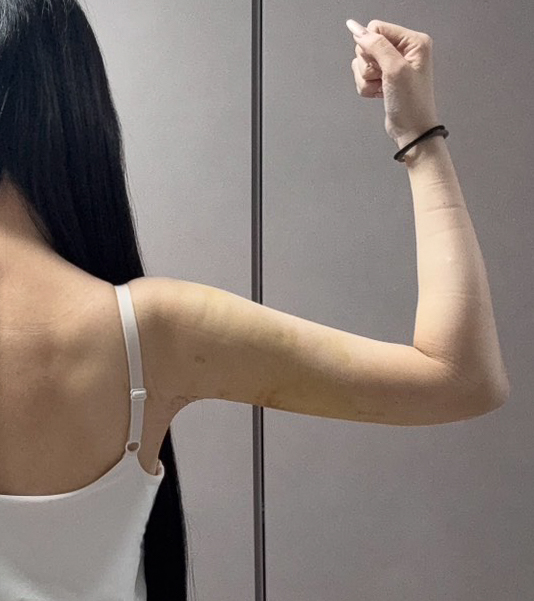 二の腕の脂肪吸引