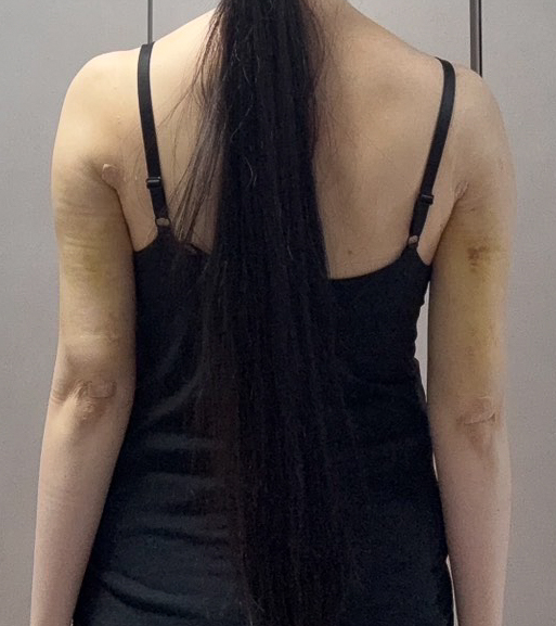 二の腕の脂肪吸引