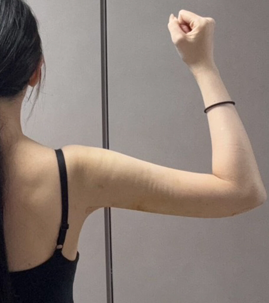 二の腕の脂肪吸引