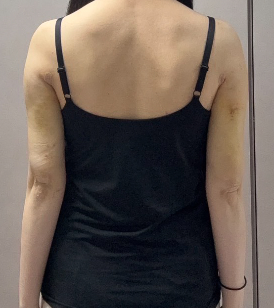 二の腕の脂肪吸引