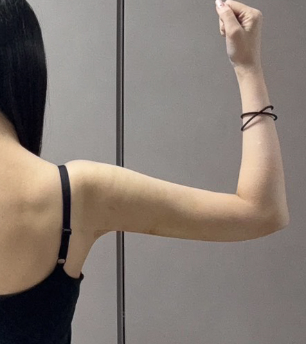 二の腕の脂肪吸引