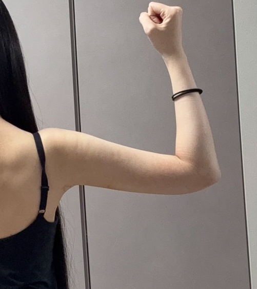 二の腕の脂肪吸引