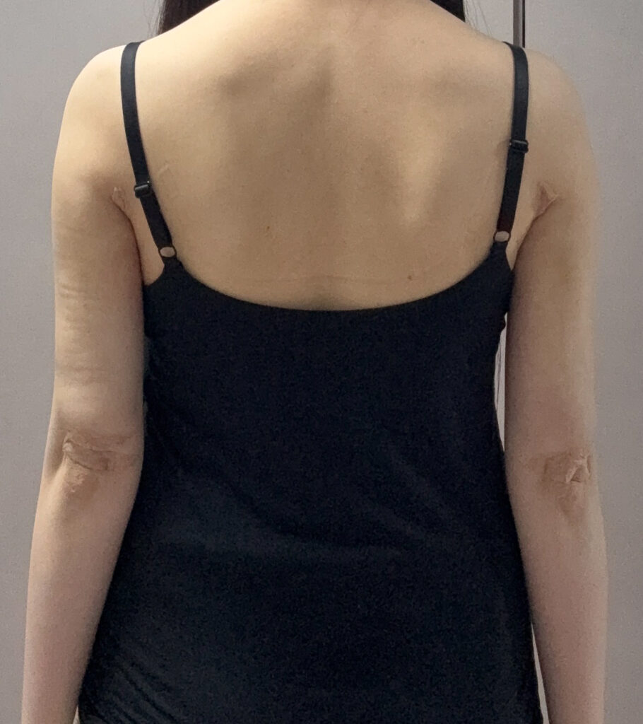 二の腕の脂肪吸引