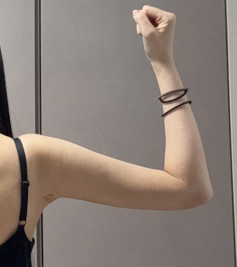 二の腕の脂肪吸引