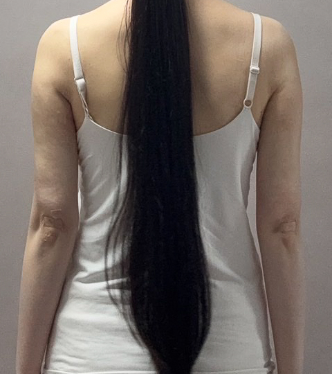 二の腕の脂肪吸引