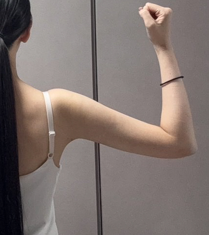 二の腕の脂肪吸引