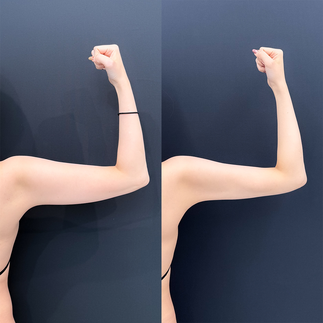 https://purelys-tokyo-clinic.com/wp/wp-content/uploads/2026/01/arm-Liposuction_Case-No.346.jpg