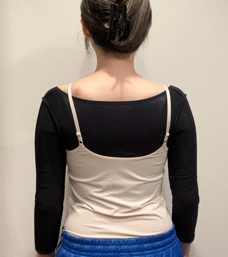 二の腕の脂肪吸引