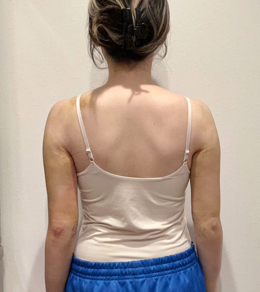 二の腕の脂肪吸引