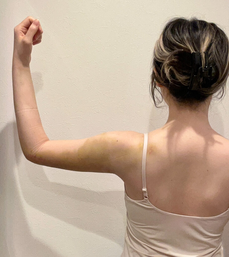 二の腕の脂肪吸引